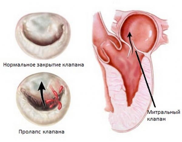 Что это, что значит диагноз и чем опасен пролапс митрального клапана сердца