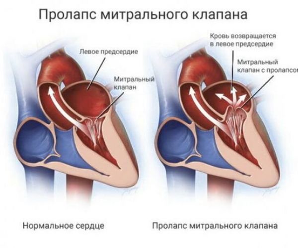 Что означает сердечный коллапс